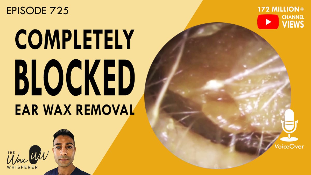 TheHearClinic's tweet photo. 725 - Completely Blocked Ear Wax Removal https://t.co/VQUCdZV9EJ via @YouTube #earwaxremoval #earwax #earwaxextractions #earwaxextraction #earwaxblockageremoval #earwaxremoving #earwaxextraction #hardearwaxremoval #earwaxmicrosuction #endoscopicmicrosuction https://t.co/pvcLUhyaQv