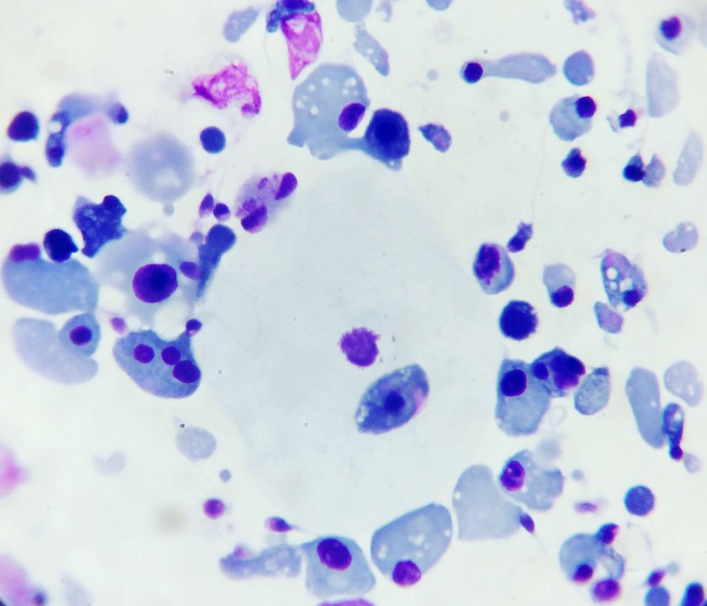 Lisaandrollab's tweet photo. #AdvancedSemenAnalysis images.
#stresspattern in #semen from man with #varicocele.
#SemenAnalysis
#spermatogenesis
#spermiogenesis
#immaturegermcells
#espermograma https://t.co/HT6TkOfZFJ