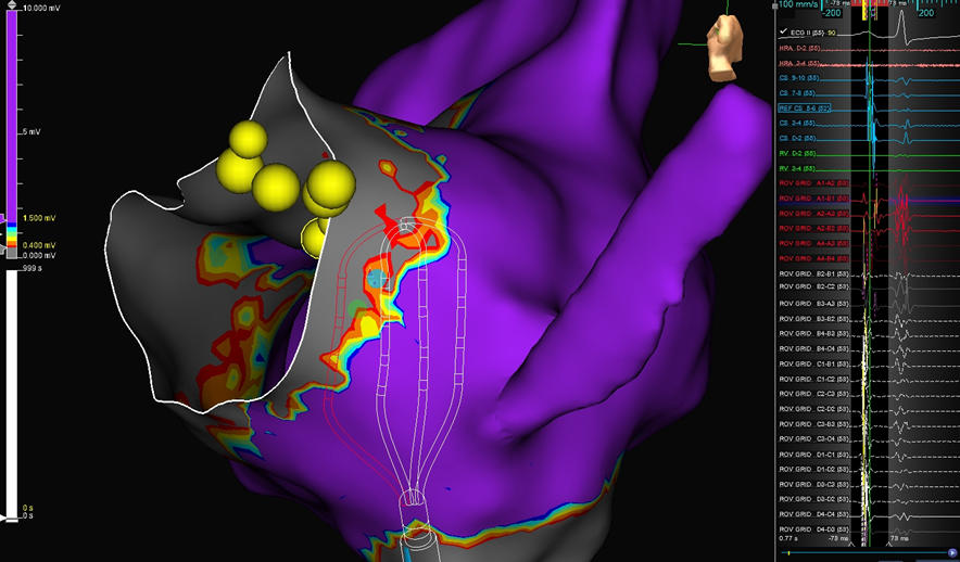 DaneshModi's tweet photo. Low voltage bridge mapping works great all around!  Here's an #HDGrid map that also demonstrates a slow pathway potential.  Expertly mapped by @BrianOttoEP
@maddyferraro1 @jeffrey_vinocur @AbbottCardio  #EPeeps https://t.co/gyC1XkejbM