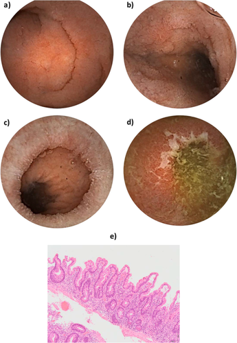 JGHofficial's tweet photo. Education &amp; Imaging | Gastrointestinal: Olmesartan-induced enterocolopathy: A new presentation of a known entity

https://t.co/VJH92dD8zn https://t.co/wuAi5zKBiy