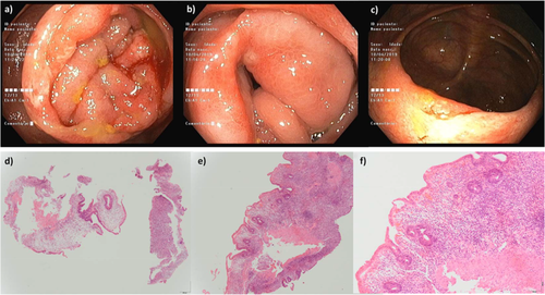 JGHofficial's tweet photo. Education &amp; Imaging | Gastrointestinal: Olmesartan-induced enterocolopathy: A new presentation of a known entity

https://t.co/VJH92dD8zn https://t.co/wuAi5zKBiy