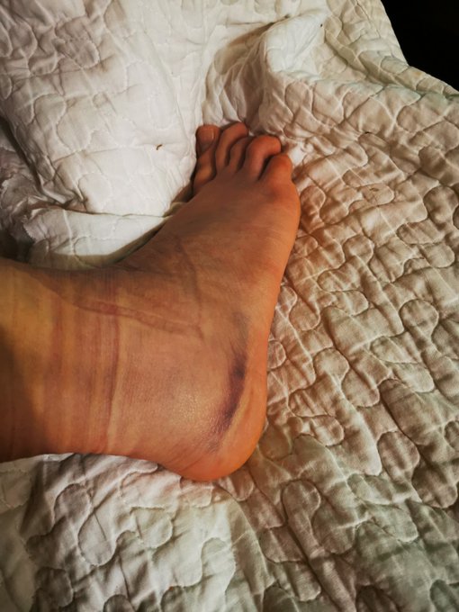 @Crossfiles12 Pues bien morado, y a&uacute;n me duele, pero ya puedo caminar. ✌🏻✌🏻✌🏻 (Favor, omitir mis piernas<a class="tags" target="_blank" title="On Twitter" href="/?out=eyJ0eXAiOiJKV1QiLCJhbGciOiJIUzUxMiJ9.eyJpYXQiOjE3MjI5ODU3OTgsImlzcyI6InR3cG9ybnN0YXJzLmNvbSIsIm5iZiI6MTcyMjk4NTc5OCwiZXhwIjoxNzU0NTIxNzk4LCJyZWRpcmVjdF91cmwiOiJodHRwczovL3R3aXR0ZXIuY29tL0Nyb3NzZmlsZXMxMiJ9.WFJ3Y5PVBNllXGxCgu8R_4cs9ppblHQSPWTDGudvabvA1mAevJ2C6cTe26DLtMDPPiBU-d95LB-ozcandXh6cg">@Crossfiles12</a><a href="/tag/stripchat"class="tags"><span>#stripchat</span></a>