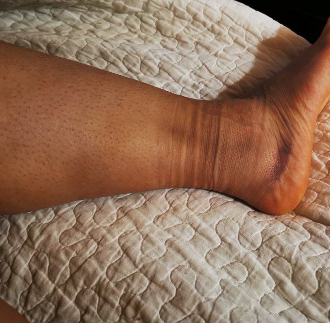 @Crossfiles12 Pues bien morado, y a&uacute;n me duele, pero ya puedo caminar. ✌🏻✌🏻✌🏻 (Favor, omitir mis piernas<a class="tags" target="_blank" title="On Twitter" href="/?out=eyJ0eXAiOiJKV1QiLCJhbGciOiJIUzUxMiJ9.eyJpYXQiOjE3MjI5ODU3OTgsImlzcyI6InR3cG9ybnN0YXJzLmNvbSIsIm5iZiI6MTcyMjk4NTc5OCwiZXhwIjoxNzU0NTIxNzk4LCJyZWRpcmVjdF91cmwiOiJodHRwczovL3R3aXR0ZXIuY29tL0Nyb3NzZmlsZXMxMiJ9.WFJ3Y5PVBNllXGxCgu8R_4cs9ppblHQSPWTDGudvabvA1mAevJ2C6cTe26DLtMDPPiBU-d95LB-ozcandXh6cg">@Crossfiles12</a><a href="/tag/stripchat"class="tags"><span>#stripchat</span></a>