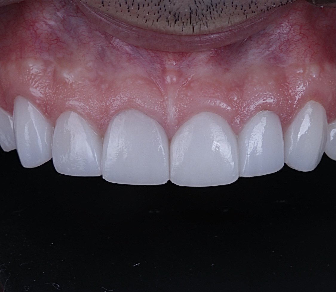 olha o antes e depois de lentes de contato dentais...