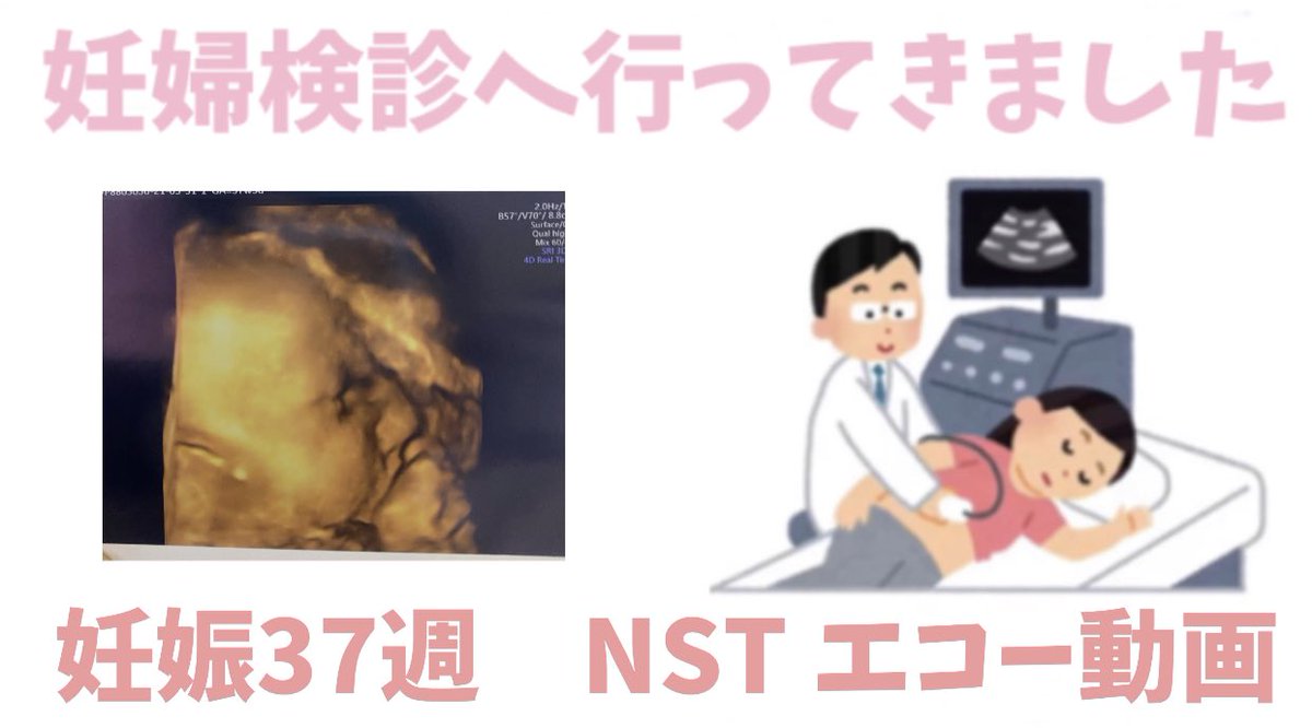 ノンストレステスト ノンストレステスト