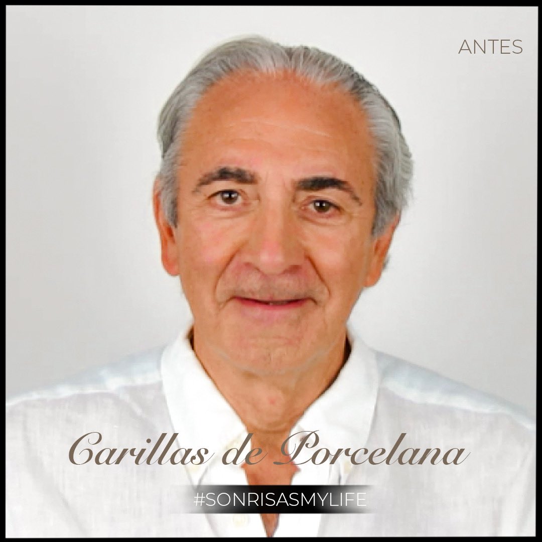 Antes de llegar a #Smylife, nuestro paciente conocía las limitaciones de su #sonrisa y apenas la mostraba. "Cuando llegué aquí me enseñaron el proceso y cómo sería el resultado final y no lo pensé". Ahora, se muestra feliz y no deja de lucir su nueva sonrisa. #diseñodesonrisa