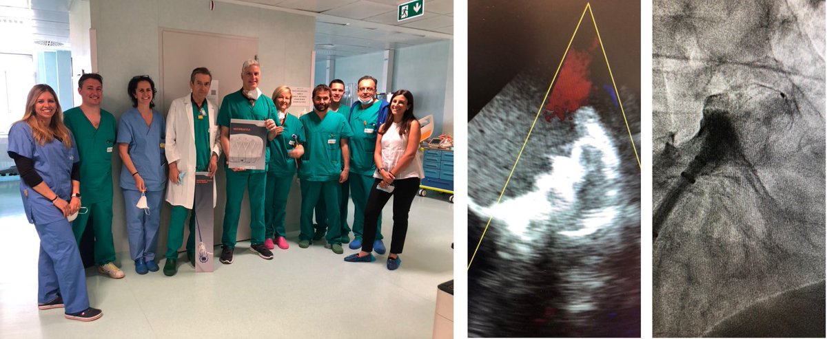 Congrats to Dr. Francesco Tomassini, Dr Ferdinando Varbella and Team at Ospedale di Rivoli AST TO 3 who perfomed their 1st WATCHMAN FLX LAAC procedure for the CHAMPION-AF Clinical Trial designed to evaluate the safety &amp; efficacy of #WATHCMAN FLX vs NOACs in NVAF patients.