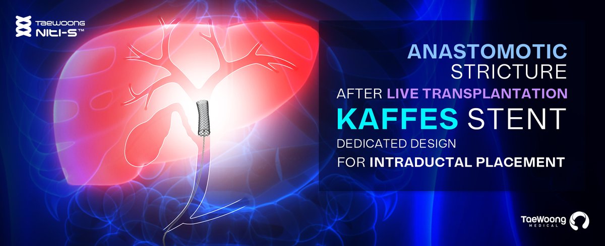 taewoongmedical's tweet photo. Niti-S "Kaffes" stent is a dedicated designed metal stent for anastomotic stricture after liver transplantation.

Please find out more information :
https://t.co/veInzlf4wb (procedure and articles)
https://t.co/kobDbHoSW6 (product information for order)
#taewoongmedical #taewoong https://t.co/yfWJgH5koH