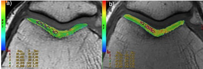 RadiolMed's tweet photo. Editor's Pick: MRI
T2-mapping MRI evaluation of patellofemoral cartilage in patients submitted to intra-articular platelet-rich plasma (PRP) injections
https://t.co/e4dMGRtobR
#radiology @ClinMedJournals @_sirm @mediOrthopaedi1 https://t.co/e8leBCvasR