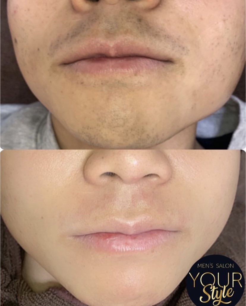 メンズ脱毛your Style Yourstylemens Twitter