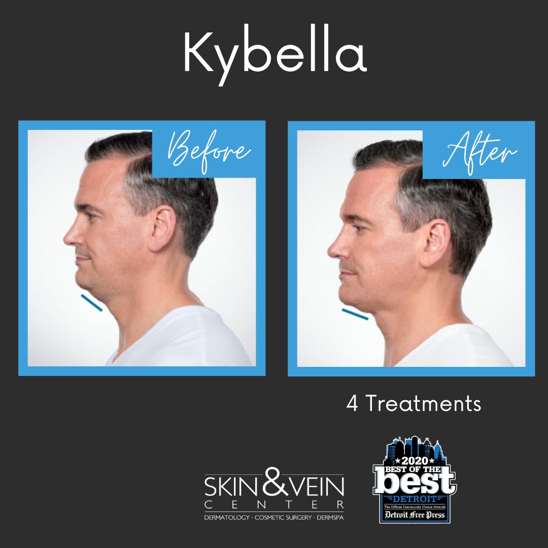 If diet and exercise aren't enough, call us to schedule your Kybella consultation. Kybella removes your double chin without surgery or pain. 

#kybella #necklift #nonsurgicalnecklift #doublechin #kybellatreatment #doublechintreatment #skinandvein #skinandveincenter