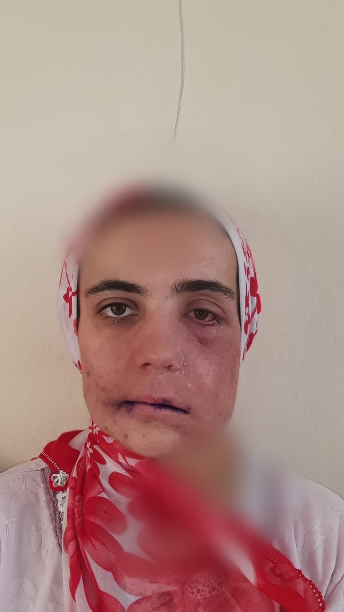 "Nakil yapılan doku ve kemik tam yerleşmedigi için en ufak bi tozda basit bi sogukta 3 dk başima önüme egdigimde yüzüm bu hale geliyor"   

Ve 9 küsür yıllık olmayan suçtan dolayı cezası onandı..

#AyşeÖzdoğanTutuklanamaz