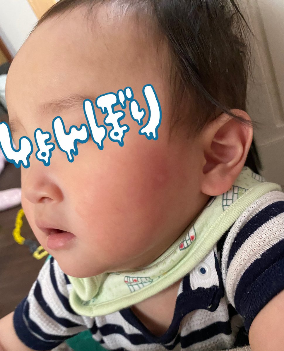 Acom0324 1y 午前中にほっぺ蚊に刺されたのかと思ってお出かけしたらみるみる赤みが広がってきて病院に 多分 卵アレルギー 卵黄丸々一個もたまごボーロも問題なかったボーイなんだけどスープに卵黄を入れてあげたのがもしかしたら少し半生だったのか Acom0324 1y 午前中にほっぺ蚊に刺されたのかと思ってお出かけしたらみるみる赤みが広がってきて病院に 多分 卵アレルギー 卵黄丸々一個もたまごボーロも問題なかったボーイなんだけどスープに卵黄を入れてあげたのがもしかしたら少し半生だったのか
