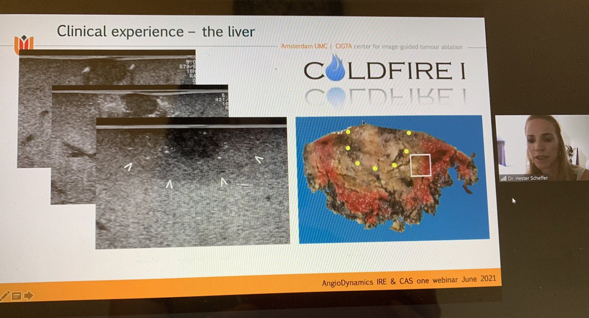 TzeWah1's tweet photo. Great talk from Dr Scheffer on her work on IRE and future with IRE & Immunotherapy 😊 Thank you @samjeans @CAScination and @RebeccaHagen15 @angiodynamics for chairing this women expert panel on combining technologies in #IO #inspirational 🌟 https://t.co/hdlLTvgJ3r