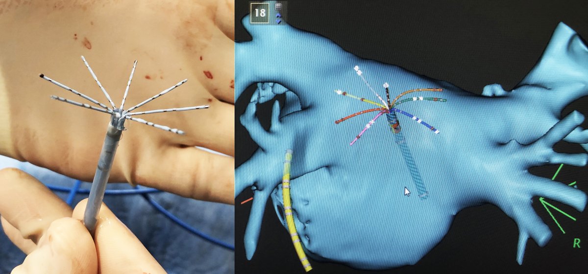 MBergonti's tweet image. 08/06/2021 - First European cases with #Octaray, @BiosenseWebster mapping catheter. Fast mapping, clear signals, very few motion artifacts. #HDmapping, #Epeeps

with @AndreaSarkozy and @HH4EHRA 
Thanks to @Salavtore4, Stefan Henkens, Inge Benoy, Dan Steinberg
At #UZA, Antwerp.