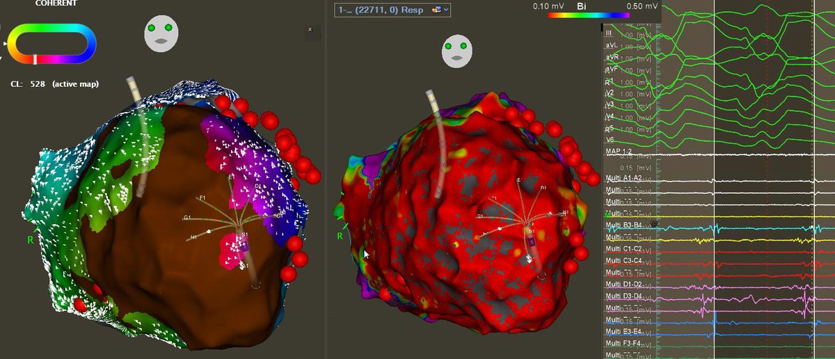 MBergonti's tweet image. 08/06/2021 - First European cases with #Octaray, @BiosenseWebster mapping catheter. Fast mapping, clear signals, very few motion artifacts. #HDmapping, #Epeeps

with @AndreaSarkozy and @HH4EHRA 
Thanks to @Salavtore4, Stefan Henkens, Inge Benoy, Dan Steinberg
At #UZA, Antwerp.