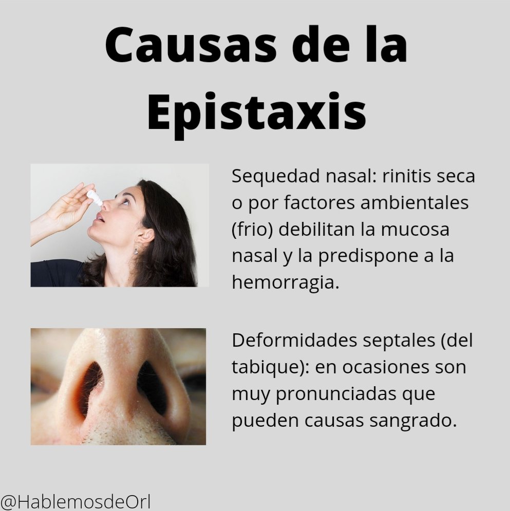 HablemosdeOrl's tweet photo. #HablemosdeOrl #otorrino #otorrinolaringología #salud #medicina #orl #epistaxis #nariz #recomendaciones #лор #оторриноларингологиа #нос https://t.co/h9JWhQvnof