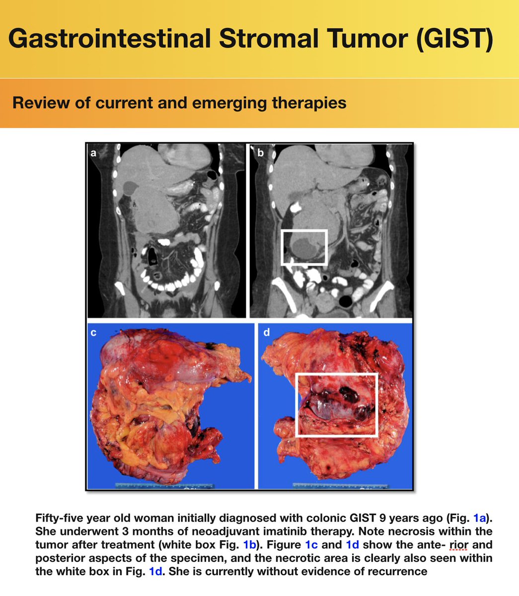 In this comprehensive review of gastrointestinal stromal tumor (GIST), we discussed standard of care and future paradigm shifts in therapy

Link:
pubmed.ncbi.nlm.nih.gov/33876372/

<a href="/BayanShare/">Bayan Al-Share</a>, <a href="/NajeebAl_Hallak/">Najeeb Al Hallak</a>, <a href="/asfarsazmi/">ASFAR AZMI</a>, Hafiz Uddin, Ramzi Mohammad, Steve Kim, @TonyFShields, <a href="/paphilip/">philip a philip</a>