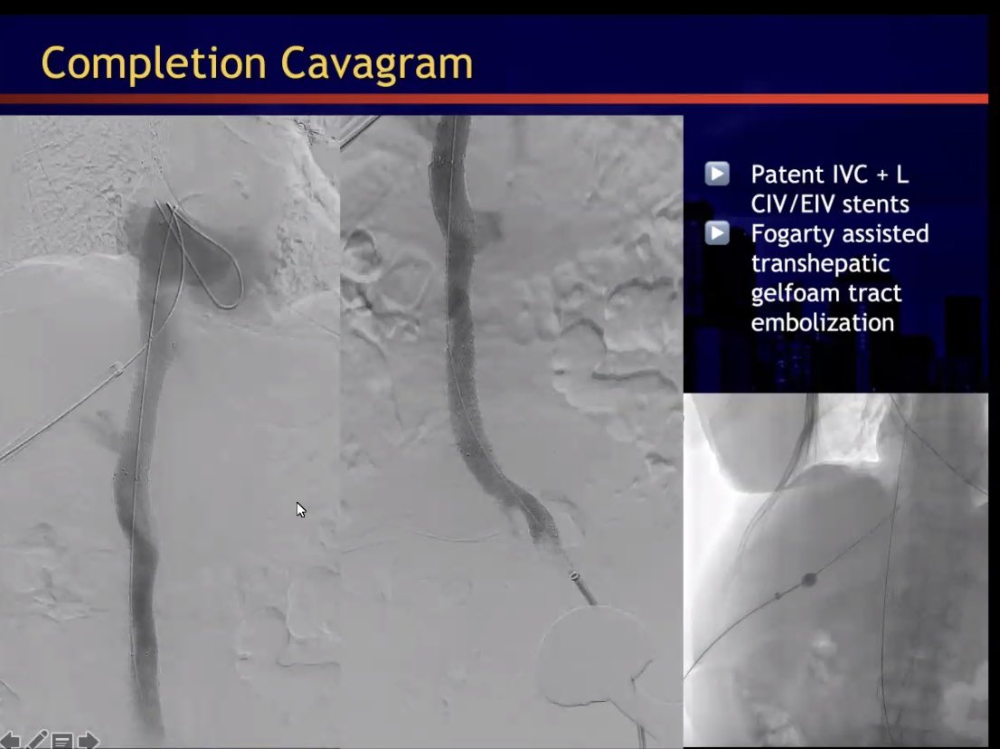 LIVE <a href="/MountSinaiIR/">Mount Sinai IR</a> <a href="/IrNyrs/">NYRS IR</a> #angioclub Best Case of the Year Comp! 🔥
- 41 yo critically ill ESRD patient w/ chronic central venous occlusion of almost every vein, requiring emergent HD for hyperkalemia w/ malfunctioning permcath, treated w/ central venous recan @OmoKinju #irad