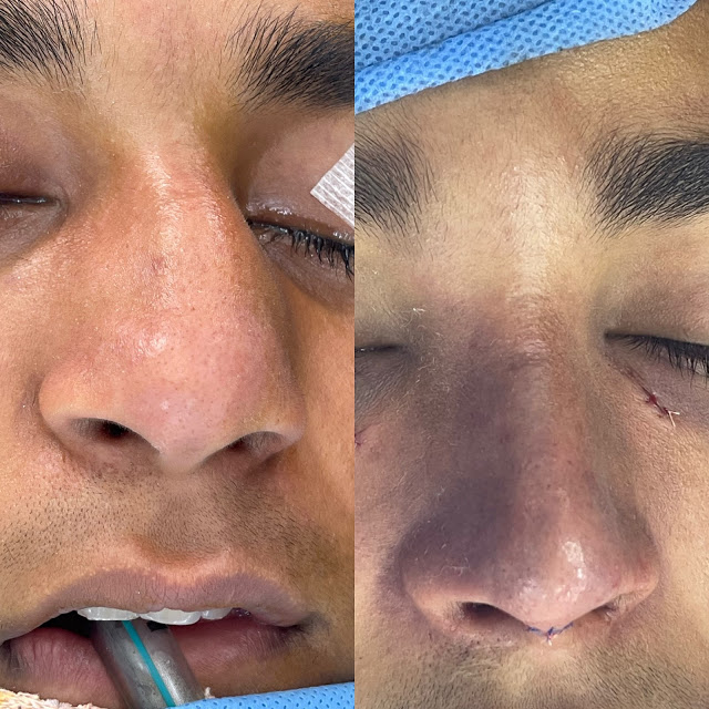 AndeiSoI's tweet photo. #Deviated or Bent Nose Correction by nasal
Osteotomy and Septal #Reconstruction in India https://t.co/Y8jdzRKxDV
