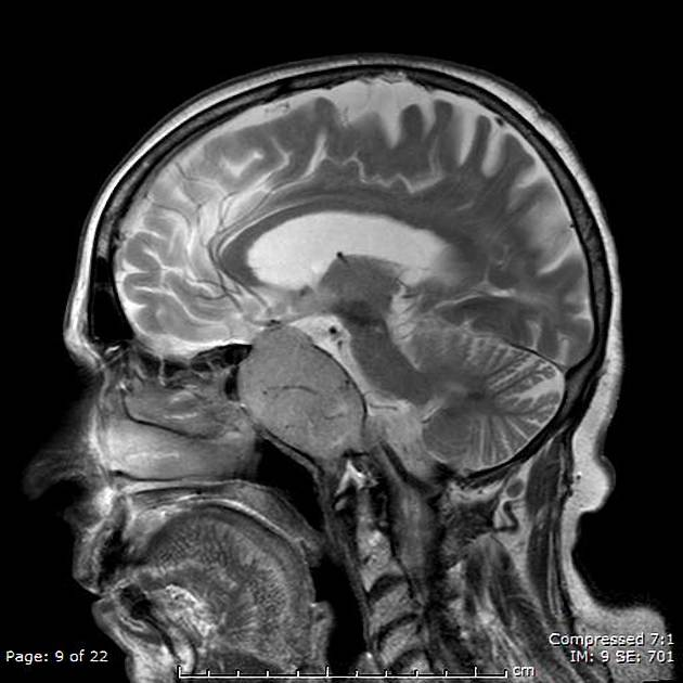 Q: Headaches and worsening vision. Does your list of pituitary region masses include this diagnosis?
ANSWER: goo.gl/hGB0j9
#FOAMrad #FOAMed