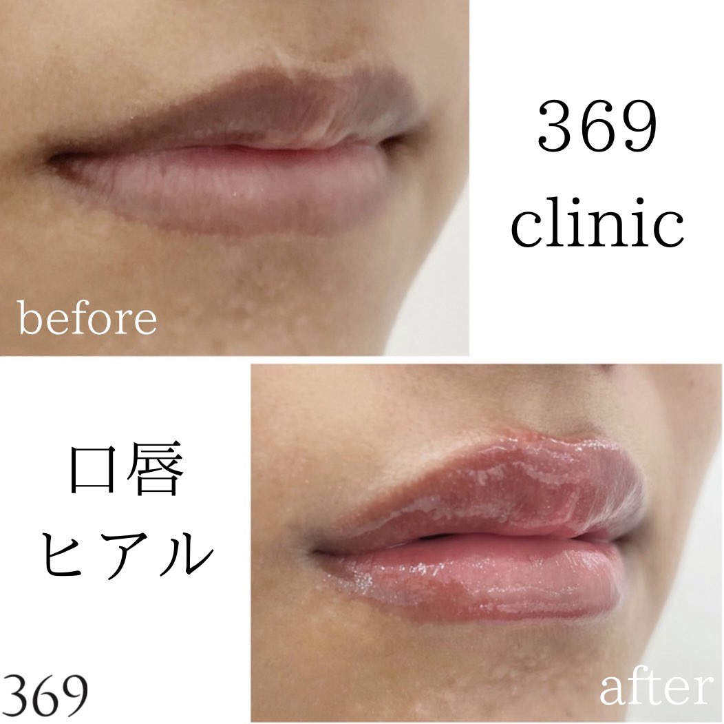 美容皮膚科369clinic ミロククリニック 当院の唇ヒアル症例です こちらの患者様はm字リップ希望はなく 人中短縮する様に薄い唇を厚くしたいとのご希望でした ナチュラルにボリュームアップし 形が綺麗に整いました 施術の詳しい内容は当院