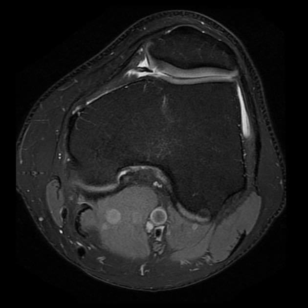 Radiopaedia's tweet photo. Q: 35yo male with superomedial knee pain. What’s the diagnosis?
ANSWER: https://t.co/jKDAVwZXEd
#FOAMrad #FOAMed https://t.co/7u7OwxKGGN