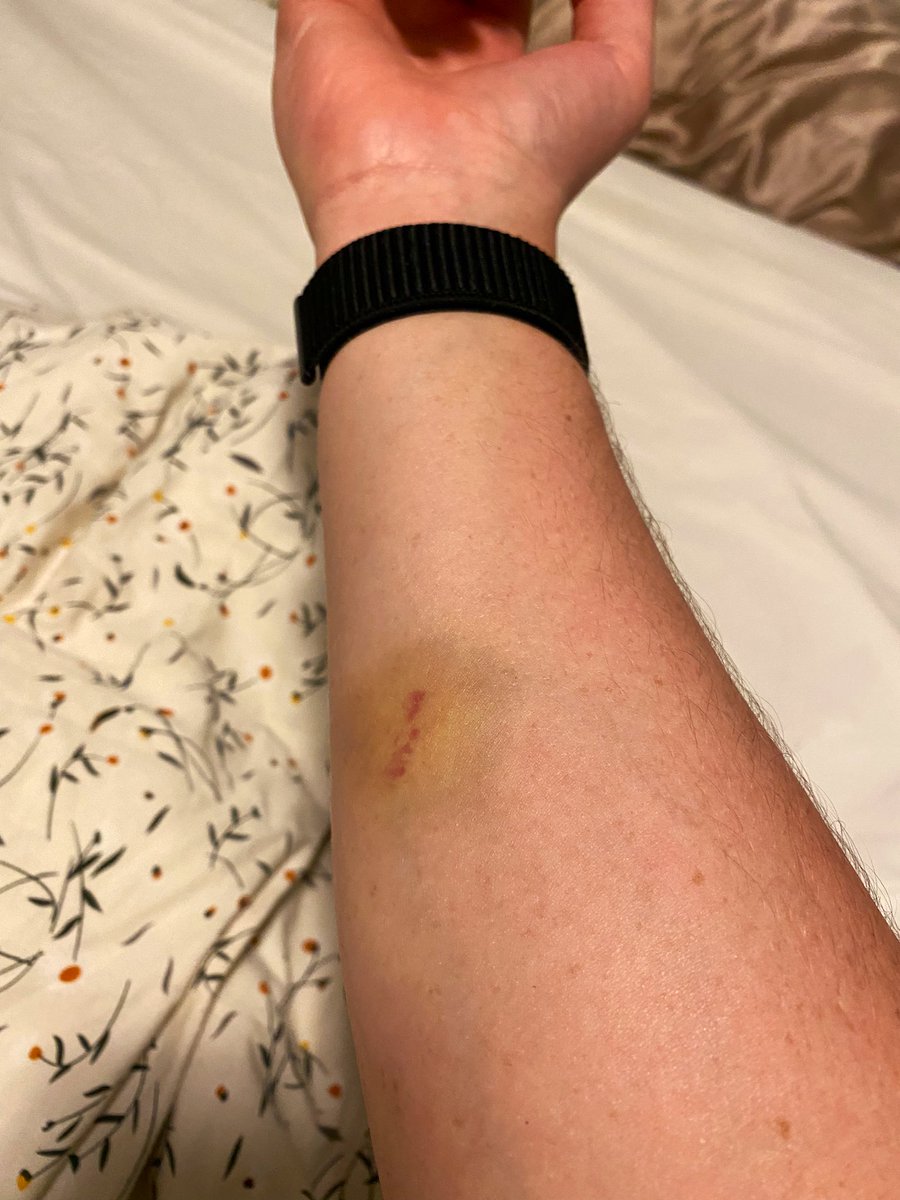Avistheman's tweet photo. Some patients leave marks on your heart ❤️ Others leave them on your body 💫 https://t.co/RSXKTbLrGu
