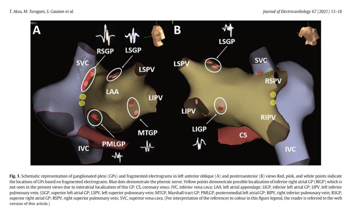 How CNA differs from cardiac pacing in terms of ventricular repolarization. Read in the latest issue of @JElectrocardiol. From @MDTolgaAksu @gautamsand @mohitkturagam @ftrae @drerkanbaysal @DrSerdarBOZYEL @YalinKivanc @drrakeshg1 @DJ_Lakkireddy bit.ly/3wEpPdj
