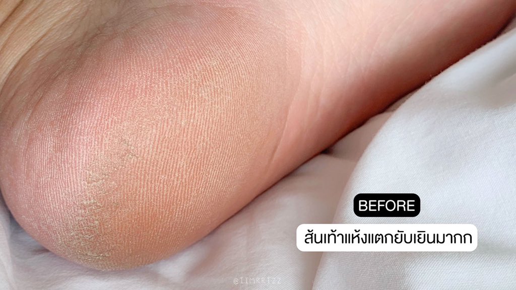 arnathaofficial's tweet image. อัศจรรย์ใจมาก ไม่คิดว่าจะดีขนาดนี้ Eucerin Aquaphor Spray สเปรย์ล็อคผิวชุ่มชื้นของยูเซอริน ความแห้งกร้านทั้งหลายแตกกระเจิงไปหมดเลยจ้า ผิวแห้ง เข่าด้าน ศอกแตก หายหมด นี่ฉีดส้นเท้าที่แห้งแตกแบบไม่ไหวแล้ว ฉีดแล้วใส่ถุงเท้าทิ้งไว้คืนนึง ตื่นมาถอดถุงเท้ามางงเลย เหมือนได้เท้าใหม่