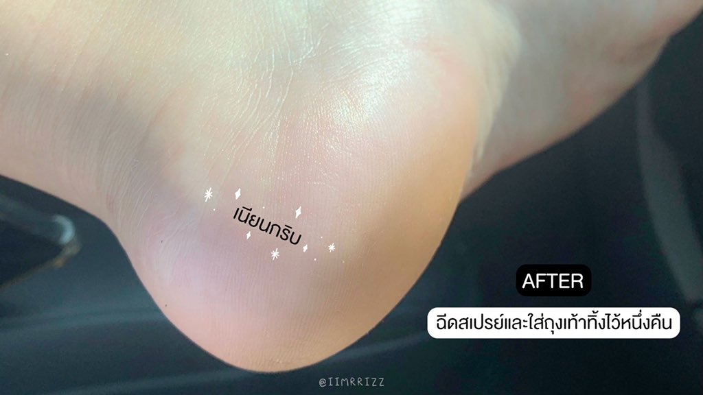 arnathaofficial's tweet image. อัศจรรย์ใจมาก ไม่คิดว่าจะดีขนาดนี้ Eucerin Aquaphor Spray สเปรย์ล็อคผิวชุ่มชื้นของยูเซอริน ความแห้งกร้านทั้งหลายแตกกระเจิงไปหมดเลยจ้า ผิวแห้ง เข่าด้าน ศอกแตก หายหมด นี่ฉีดส้นเท้าที่แห้งแตกแบบไม่ไหวแล้ว ฉีดแล้วใส่ถุงเท้าทิ้งไว้คืนนึง ตื่นมาถอดถุงเท้ามางงเลย เหมือนได้เท้าใหม่