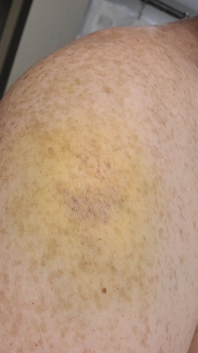 MrDadOfThree's tweet photo. The damage from @MikeChandlerMMA punching me last week as we raised $1k for #LegendsForKids.. https://t.co/NxRIFijczQ
