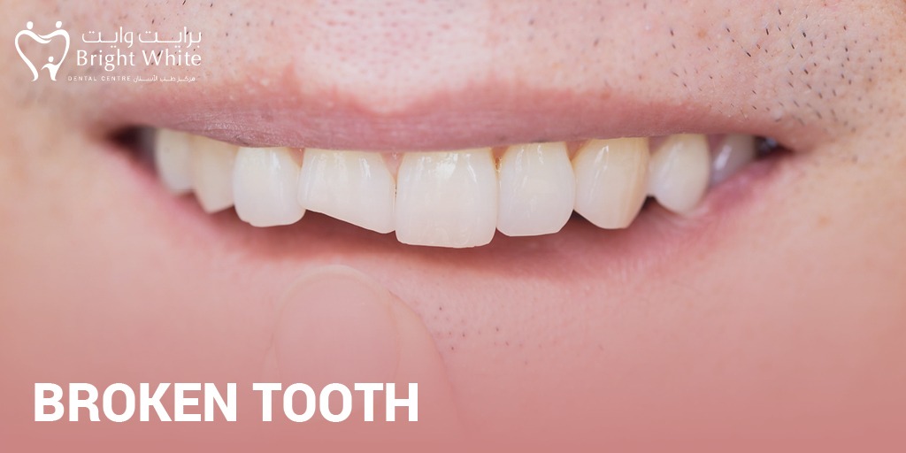 BrightWhiteae's tweet photo. If you have chipped off just a small piece of tooth enamel, your dentist may repair the damage with a filling.
 إذا كنت قد كسرت فقط قطعة صغيرة من مينا الأسنان ، فقد يقوم طبيب الأسنان بإصلاح الضرر بحشو.

#brightwhiteae #dental #dubai #UAE https://t.co/MkvEQLGKE0
