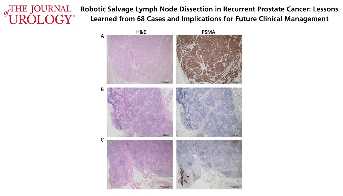 Robotic Salvage Lymph Node Dissection in Recurrent Prostate Cancer: Lessons Learned from 68 Cases and Implications for Future Clinical Management 

bit.ly/2RT3fyd <a href="/JLinxweiler/">Johannes Linxweiler</a>