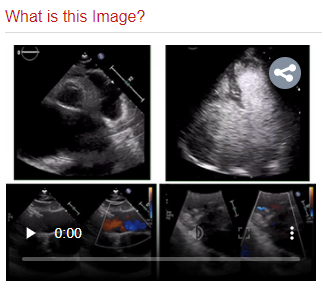 CASEfromASE's tweet photo. Is it an unroofed coronary sinus? Test your echo acumen with the new CASE What is this Image? quiz. Visit https://t.co/gVg5WN8ceQ to answer! @ASE360 https://t.co/ZRrwWHA9RB