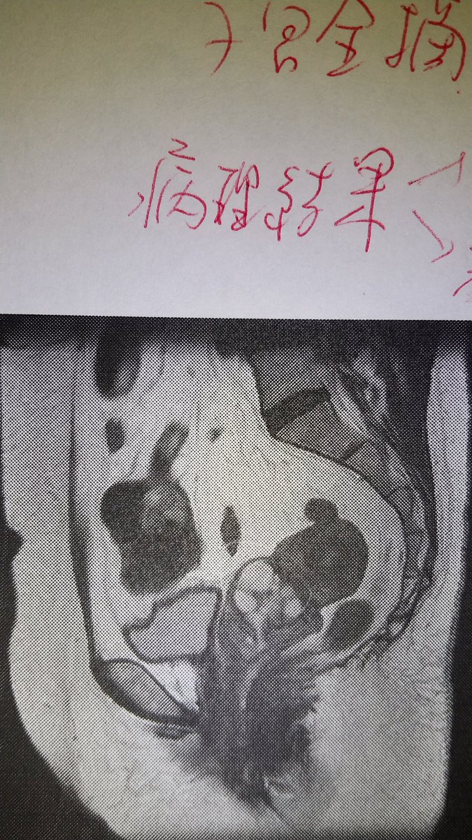 開腹 手術 腹筋