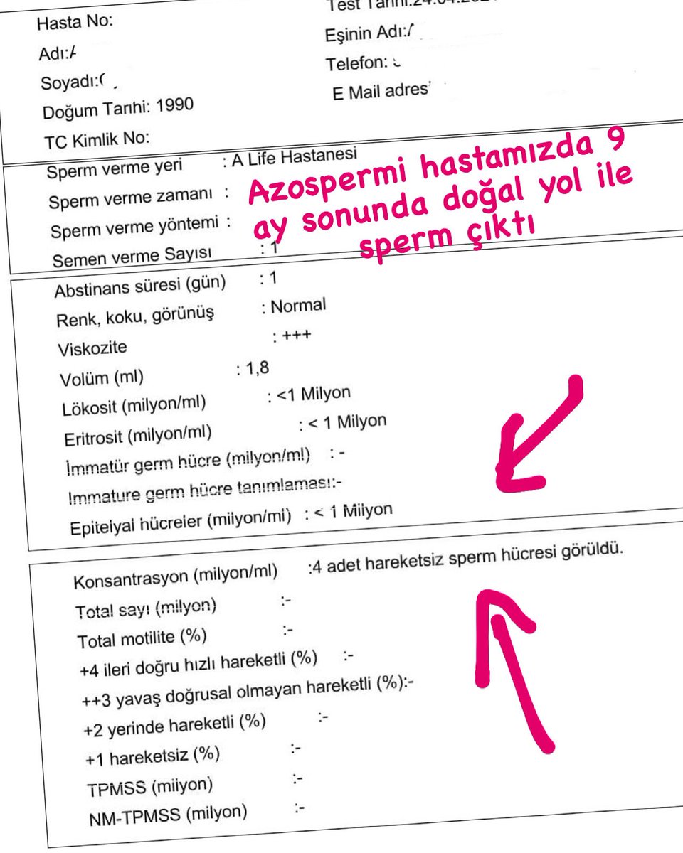bugrabuyrukcu's tweet photo. 2- çünkü doğal yolla sperm çıkmıştı ✅🧬 hemen dondurduk 🔬❄️ son tahlilde hareketli sperm de bulunca tüp bebek aşamasına da geçtik 🧚🏻♂️👼🏻 şimdi sıra burada başarılı sonuç almada 👨⚕️☯️💯 #azospermi #azospermia #azospermitedavisi #infertilite #infertility #drbugrabuyrukcu https://t.co/1MEaZvjGhZ