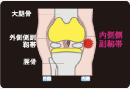 内側側副靱帯損傷 内側側副靱帯損傷
