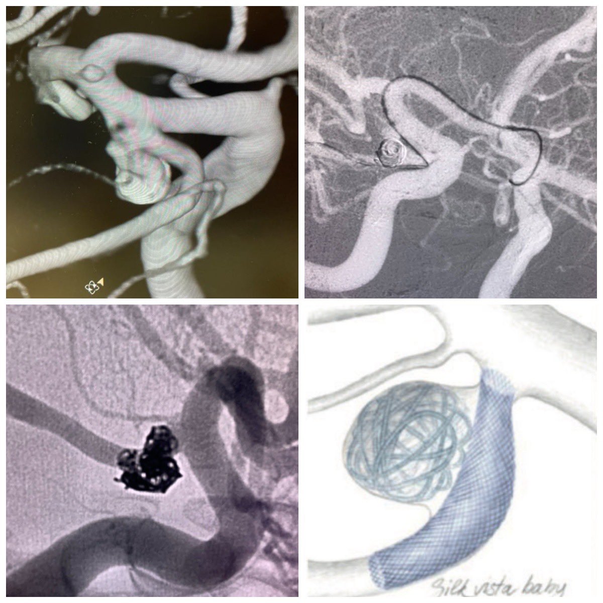 Low-profile Flow diverters are changing some conventional approaches. We performed another case of a Fetal Pcom aneurysm with an arterial closed angle by placing a Silk Vista Baby device in half-T configuration deployed by a transcirculation approach pubmed.ncbi.nlm.nih.gov/32967502/