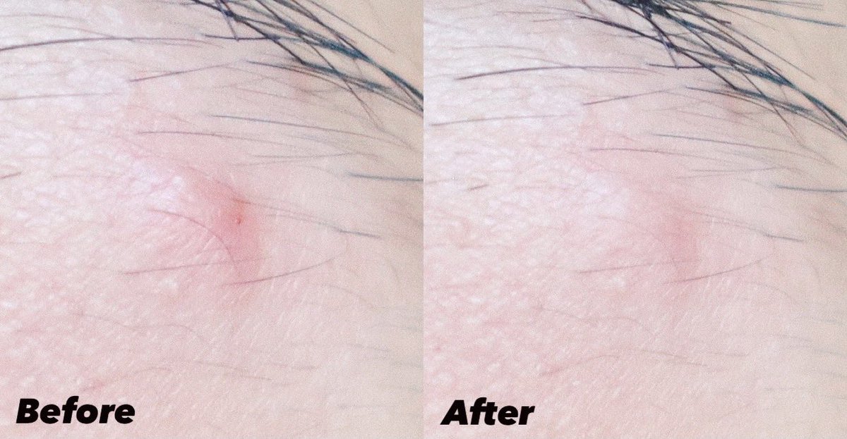 bewtyjunkie's tweet photo. ยืนหนึ่ง! ยาแต้มสิวสามัญประจำบ้าน Smooth E Ance Hydrogel Plus ใครโดนสิวไม่มีหัวบุกบ่อยๆ หลอดเขียวตัวนี้ช่วยได้ หลัง 24 ชั่วโมงน้องก็เริ่มเห็นผลแล้ว ไม่ต้องเข้าคลินิก ตัวนี้ไม่มีสเตียรอยด์ด้วย ใช้ติดต่อกันได้ผิวไม่พัง! #สิวหายเหมือนได้เจอหมอ #สิวยุบไวใน24ชม https://t.co/NamxA0gmA0