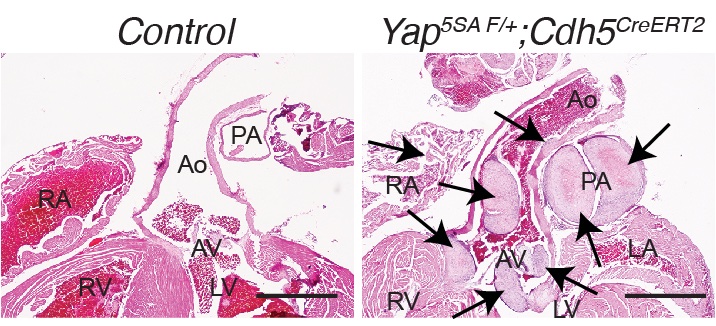 Our recent study by Roy Jung et al @trivedilab @UMassMedical @GSBS_UMassMed @UMass_Medicine show 'Sustained Activation of #Endothelial #YAP1 Causes #Epithelioid_Hemangioendothelioma' @atvbahajournals Wonderful collaborators @umassmemorial @UMassMedMCCB ahajournals.org/doi/10.1161/AT…