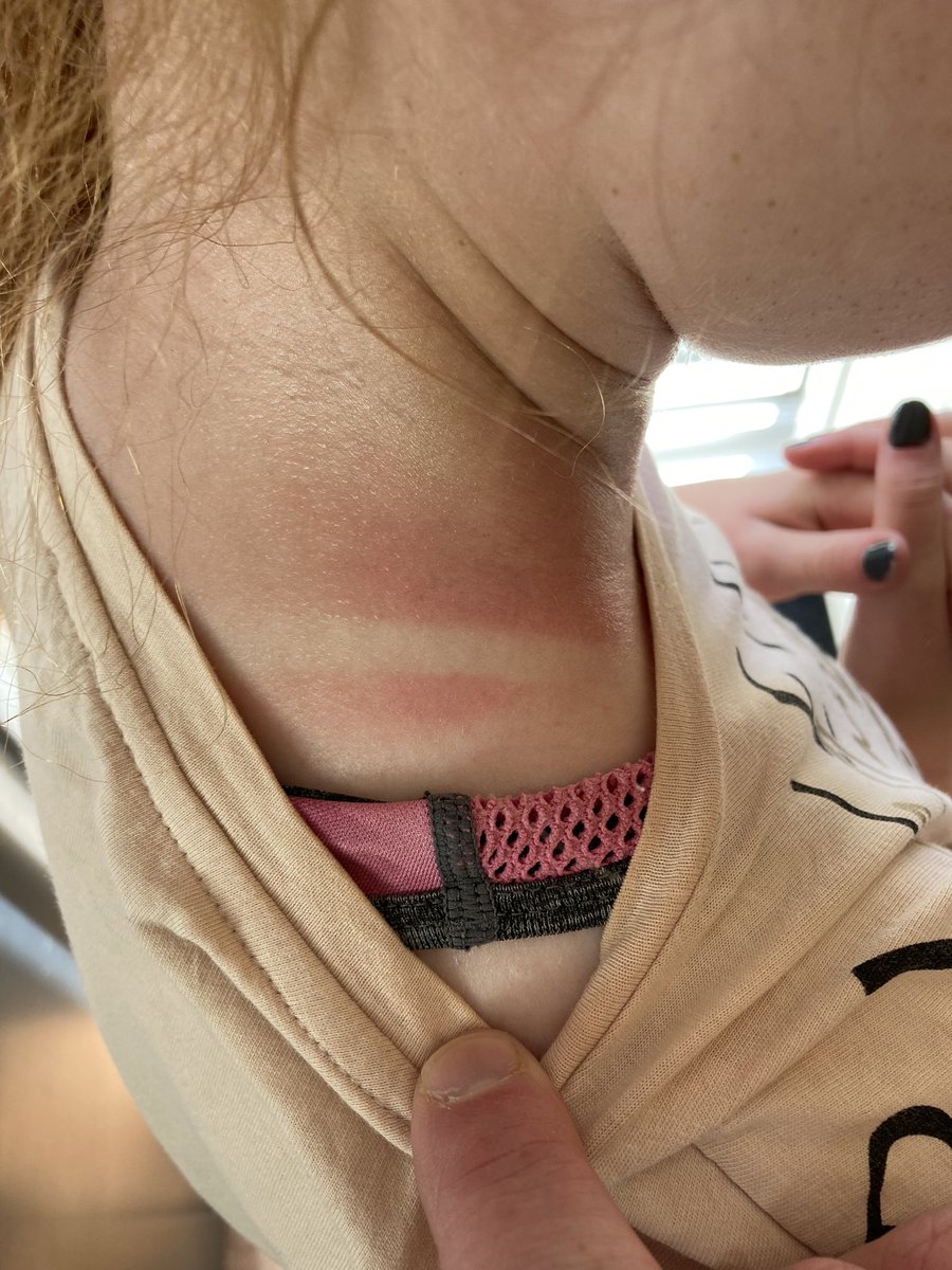 red_beacon's tweet photo. Please make sure you put lots of sunblock on your faired-skin family members. This young ginger-haired girl was burnt this week in the hot weather. #gingerfamily #gingerlife #gingerpride #mc1r #mc1rmagazine #gingerhair #gingerhairdontcare https://t.co/uCkpt3yGdv