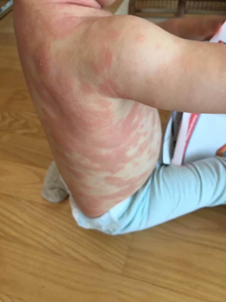 cannaworldsite's tweet photo. Atopic dermatitis treated by CBD
3 drops of 10% CBD 2 times a day for a month. https://t.co/kPxmwjZY1O