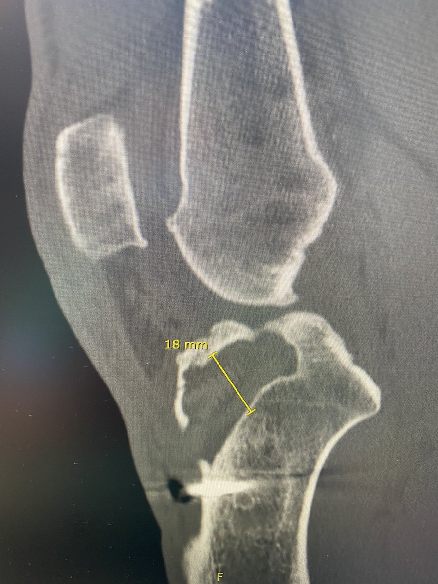 DrPJVDK's tweet photo. A synthetic ligament (or allograft) should never be the choice of graft in (first) revision ACL!
Quad, patella tendon, contralat hamstrings,...
#autograftfirst
#tunnelwidening #knee #ACL #floatingscrew #orthotwitter https://t.co/wATPLi2l1u
