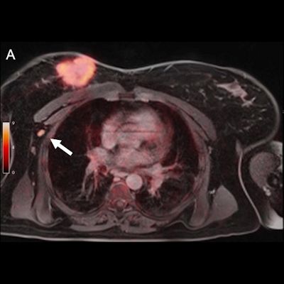AuntMinnieEuro's tweet photo. FDG #petmri combined with ultrasound can reduce the need for invasive biopsy to confirm suspicious findings in women with newly diagnosed metastatic breast cancer, write German researchers in @JournalofNucMed. https://t.co/RwD5hiHrcs #radiology https://t.co/vKzKHFKKZK