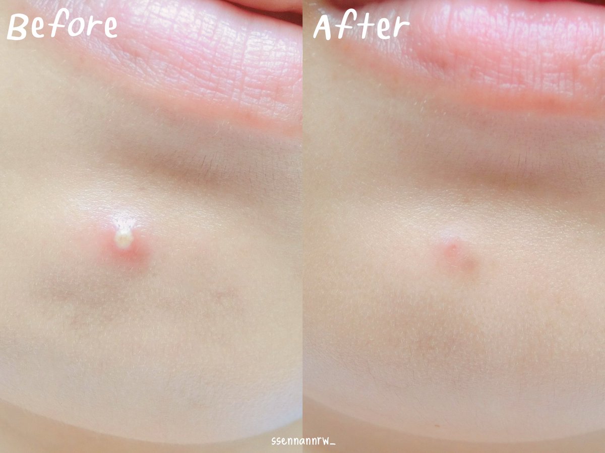 ssennannrw_'s tweet photo. เจลแต้มสิวเวชสำอางต้องให้ smooth E ยุบไวจริง ช่วงนี้สิวขึ้นบ่อยมาก ใส่แมสก์ตลอด สิวมีหัวแบบเราใช้หลอดสีขาวเท่านั้นน้า ทาทิ้งไว้ข้ามคืนเลยแต่อย่าบีบหรือโดนบริเวณสิว ตื่นมาสิวยุบแถมไม่เป็นรอยช้ำด้วย ผิวไม่ระคายเคืองเลย สองร้อยกว่าบาท พิกัดร้านยาทั่วไป #สิวหายเหมือนได้เจอหมอ https://t.co/H9RcsnpPZz