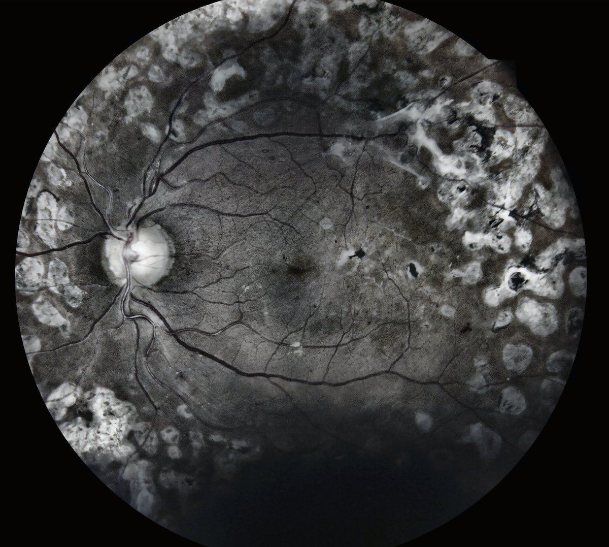 IRIStelemed's tweet image. &quot;The enhanced image does a great job of uncovering the possibility of #lipid underneath the dark shadow. The IRIS platform really does make the photos more #gradable.&quot; Jose Agustin Martinez, MD

Keep reading about IRIS Image Enhancement Software ↓

retinalscreenings.com/blog/the-iris-…