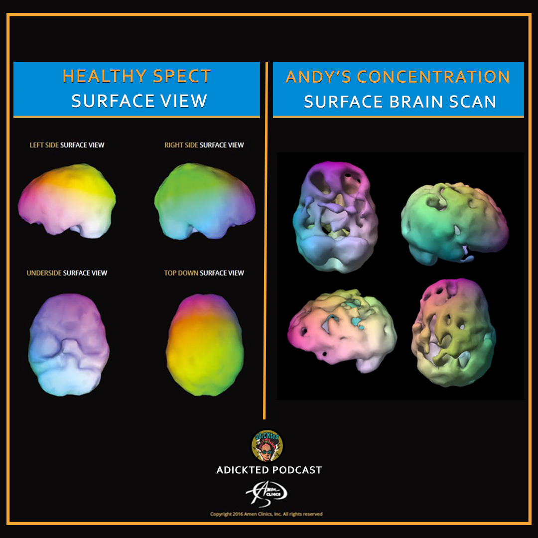 Plan on tuning into the brand new episode of #ADICKTED with #AndyDick? The image attached will come in handy as #DrDanielAmen will be explaining to Andy just how much his addictive lifestyle has literally taken a toll on his #brain. 🧠
