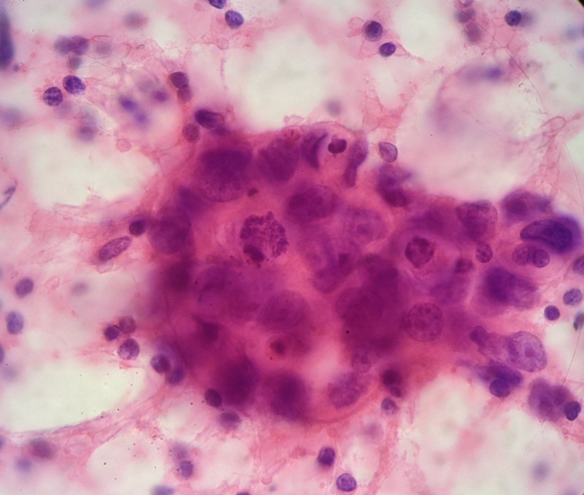 PSzwebel's tweet photo. Many ways to see Metástasic Mammary Carcinoma in an axilary Lymph node.
#PathTwitter 
#citopath https://t.co/pggDLwjUSG