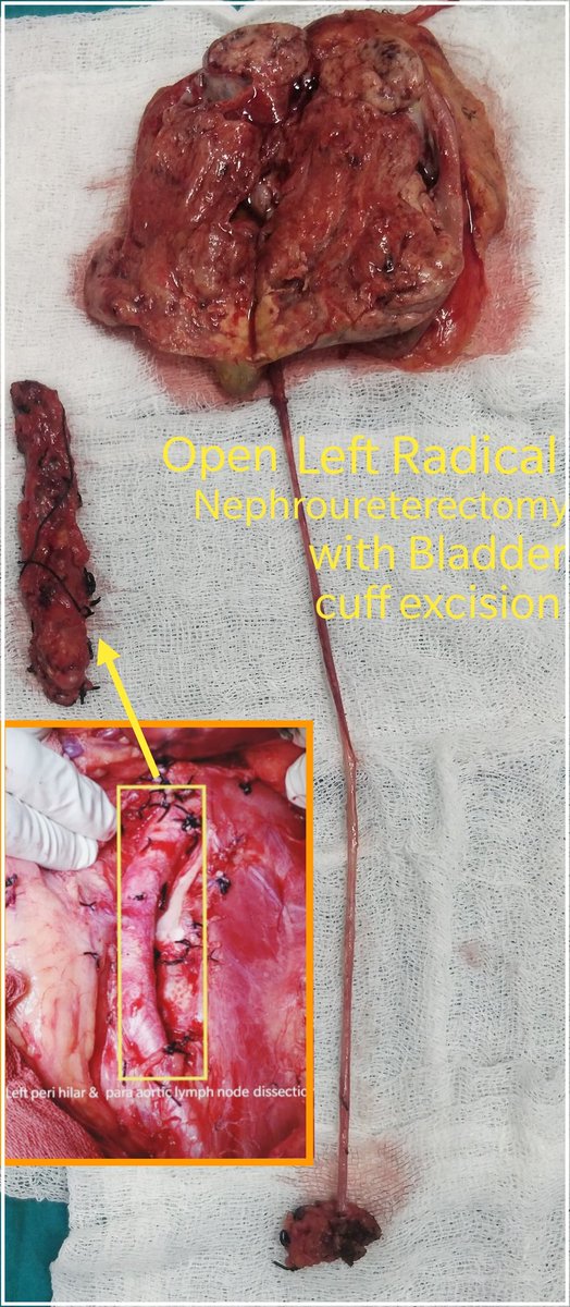 64 yr female pt with left renal pelvis  TCC. 
Open Radical nephroureterectomy with perihilar &amp; para aortic lymphadenopathy was done.
<a href="/so_uro/">UroSoMe</a> <a href="/UroResidency/">UroResidency</a> <a href="/iTRUEGroup/">i-TRUE</a>  <a href="/Uroweb/">European Association of Urology (EAU)</a>  #UTUC <a href="/YouthUSI/">YOUsi</a>